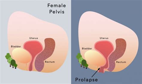 Pelvic Organ Prolapse Symptoms & Treatment | My Gynae