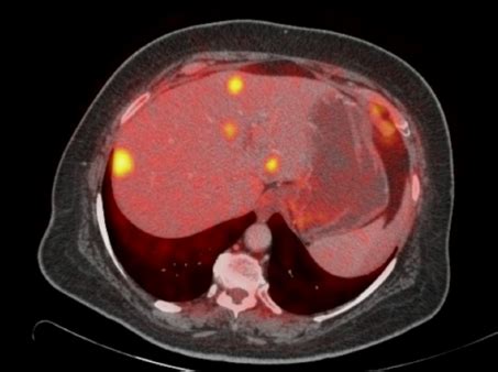 PET/CT Cancer pancreas with liver metastases    2context ...