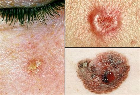 Picture Of Skin Cancer Picture Image on RxList.com