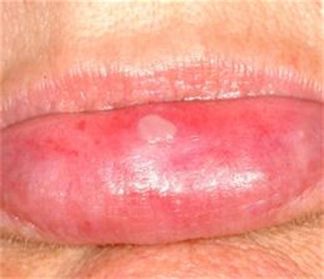 Pictures of Canker Sores and Pictures of Cold Sores