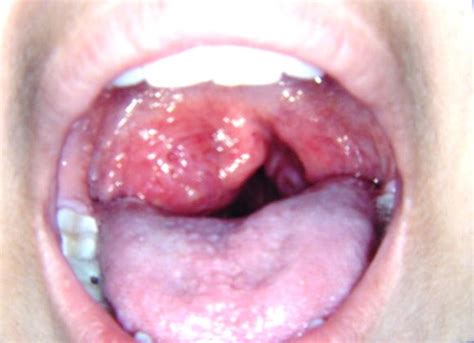 Pictures of Carcinoma and Lymphoma of the Tonsil ...