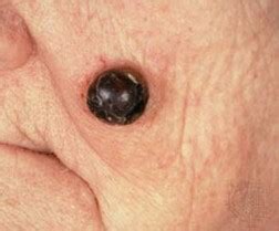 Pictures of skin cancer