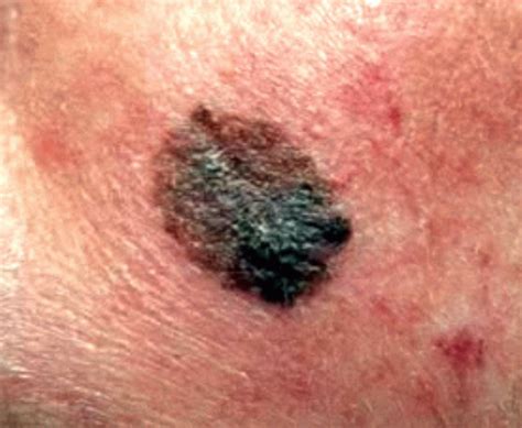 Pictures of skin cancer: Pictures of skin cancer