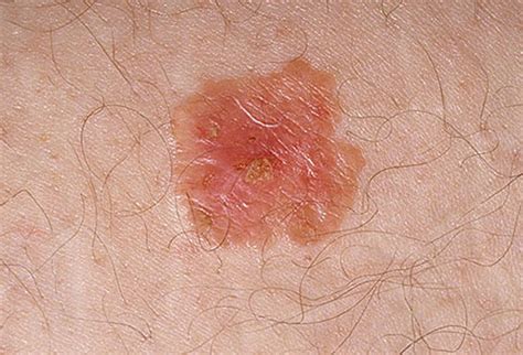 Pictures of skin cancer: Skin cancer symptoms images