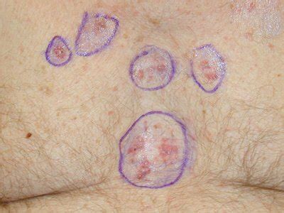 Pictures of skin cancer: Skin cancer symptoms images