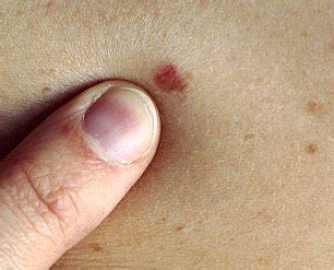 Pictures of skin cancer: Skin cancer symptoms pictures