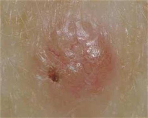 Pictures of skin cancer: Squamous cell skin cancer pictures