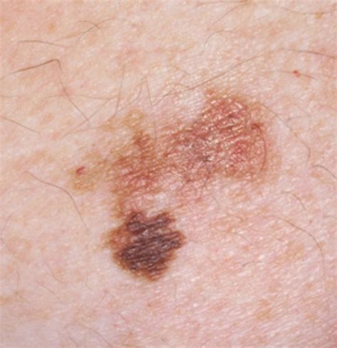 Pictures of skin cancer: Squamous cell skin cancer pictures