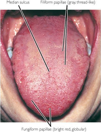 Pictures Of Tongue Cancer In Its Early Stages   Cancer ...
