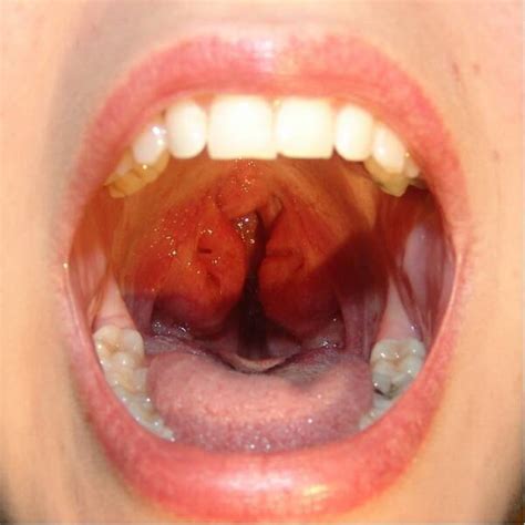 Pictures of Tonsillar Hypertrophy * OTOLARYNGOLOGY HOUSTON