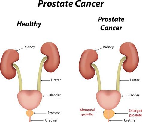 Pieza clave para el cáncer de próstata rompecabezas encontrado   Cancer ...