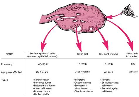 Pin by Ruthzaine on USMLE Prep | Types of ovarian cancer ...