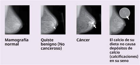 Pin en cancer
