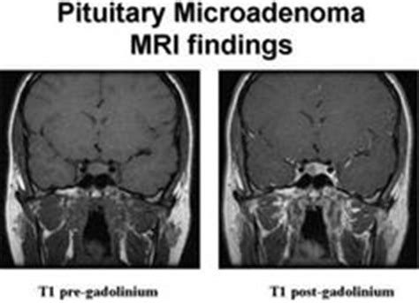 Pituitary Tumor Size Classifications Microdenoma ...