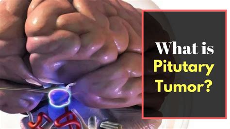 Pituitary tumor Symptoms   Causes, Pictures, Signs and ...