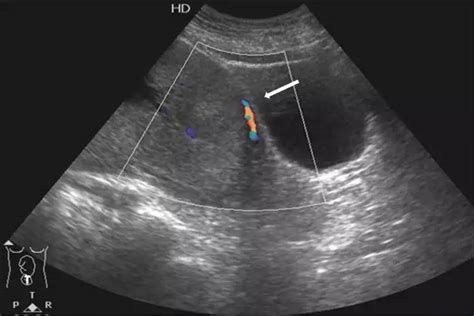 Placenta previa: Clasificación ultrasonográfica