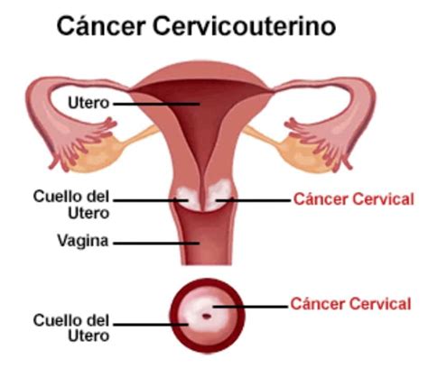 Plan para prevenir y controlar el cáncer cervicouterino en ...