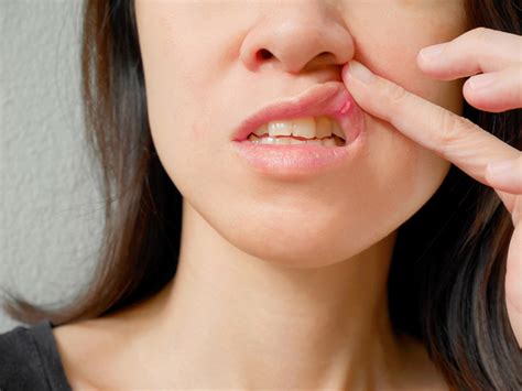 Por qué salen las llagas o aftas en la boca: causas y motivos