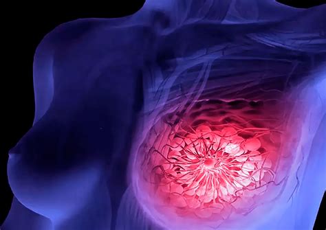 Porcentaje de mujeres con cáncer de mama metastásico viven ...