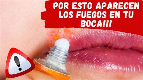 Porque salen Fuegos en la Boca   Herpes labial o fuegos en la boca ...