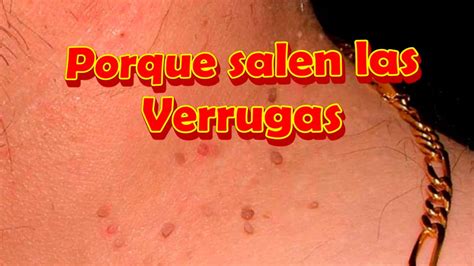 Porque salen las Verrugas en el cuello, en los Genitales, Tipos de ...