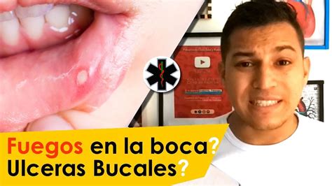 PORQUE SALEN LOS FUEGOS EN LA BOCA [ RECOMENDACIONES Y CUIDADO ]   YouTube