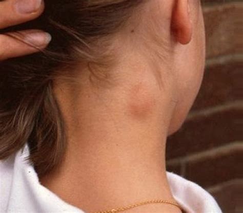 Possible Causes of Lump on the Side of Neck | New Health Advisor