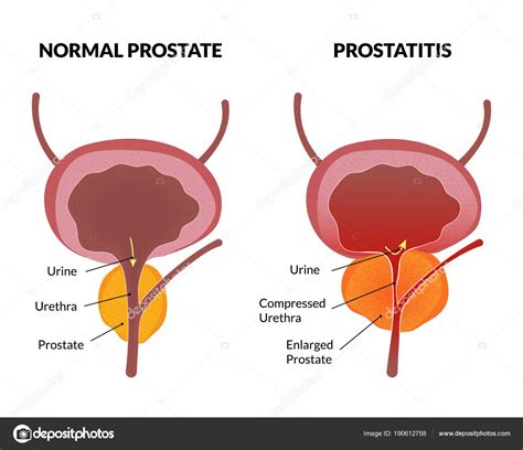 Poster de patología de la prostatitis — Vector de stock ...