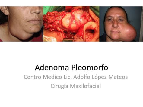 PPT  Adenoma Pleomorfo | Jorge Mery   Academia.edu