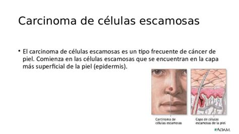 PPT  Carcinoma de células escamosas | Jose Carpintero ...