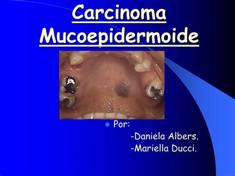 PPT   Carcinoma Mucoepidermoide PowerPoint Presentation, free download ...