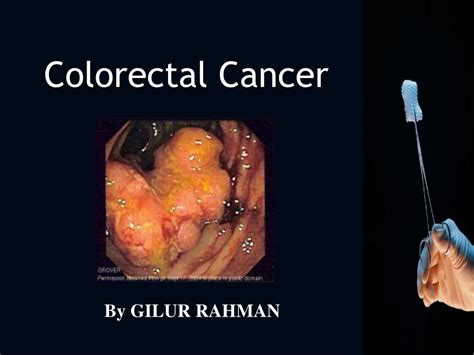PPT   Colorectal Cancer PowerPoint Presentation   ID:280501
