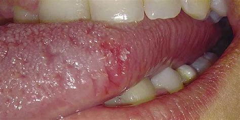 Presencia del Virus Papiloma Humano en la Cavidad Oral ...