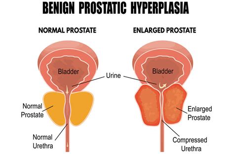 Preservación de la función sexual y Cirugías para la Hiperplasia ...