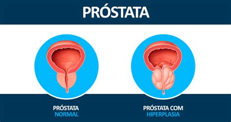 Prevenção contra o Câncer de Próstata   Clínica Doutor Saúde