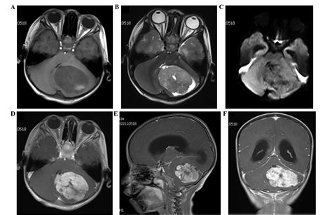 Primary cerebellar endodermal sinus tumor: A case report