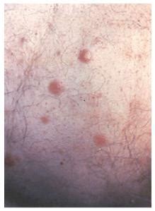 Primary cutaneous B cell lymphoma: Clinical features ...