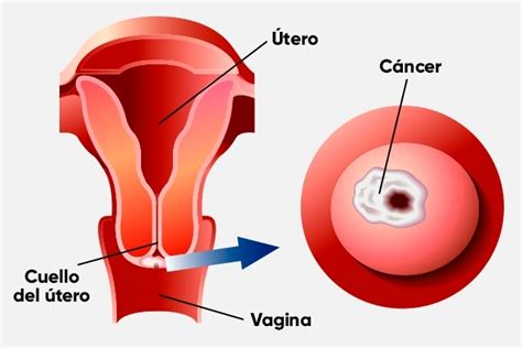 Primeros Sintomas De Cancer Cervicouterino | Healthy HesongBai