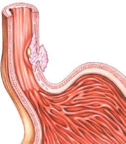 Principales enfermedades del aparato digestivo: el esófago...