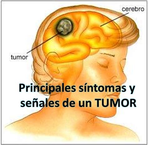 Principales síntomas y señales de un Tumor.   ★★ MUNDO ...