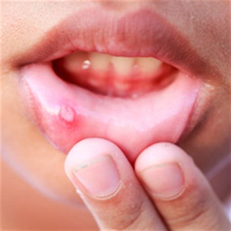 Problemas labiales: herpes y aftas, causas y remedios