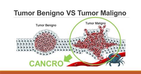 Professor Romário: Tumor Benigno x Tumor Maligno