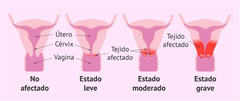 Progresión del cáncer cervical