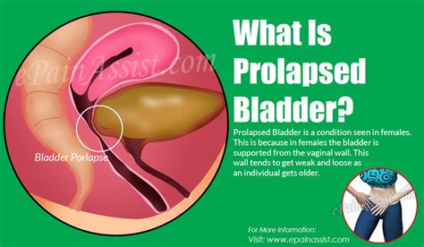Prolapsed Bladder|Stages|Causes|Symptoms|Treatment & Surgery
