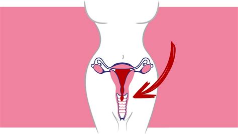 Prolapso uterino   Clínica Ginecológica