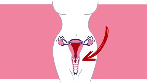 Prolapso uterino | Síntomas y tratamiento
