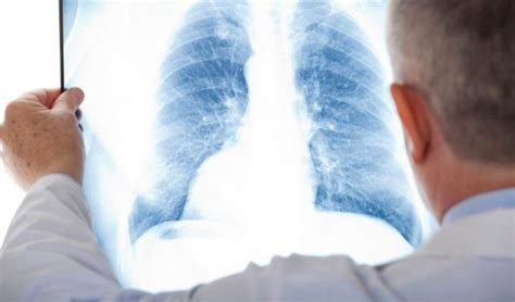 Propagación del cáncer de pulmón hacia los ganglios ...