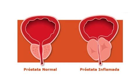 Próstata inflamada: a qué edad empieza y cuáles son sus síntomas