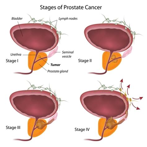 Próstata inflamada ¿Síntoma de alarma? ️ • News ProPatiens