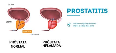 Próstata Inflamada. Todo lo que necesitas saber | ShytoBuy